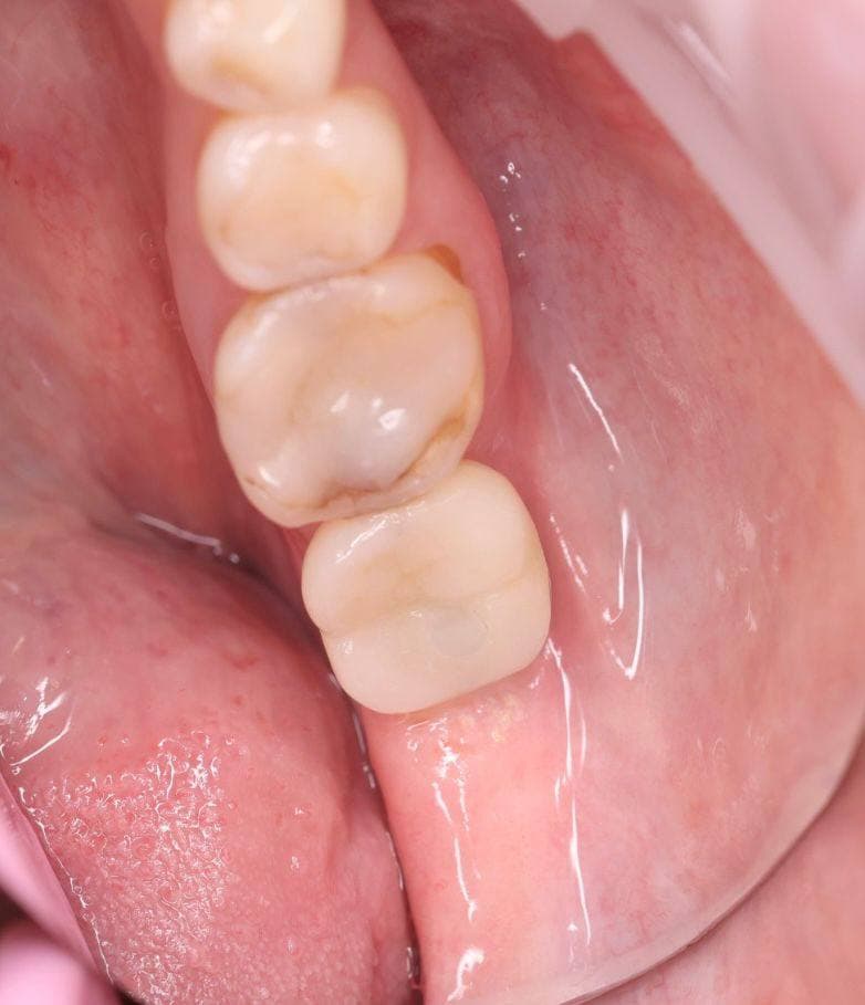 Состояние зубов 2.1 и 2.2 после реставрации