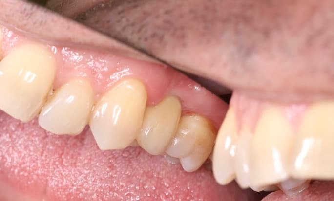 Состояние зубов 2.1 и 2.2 после реставрации