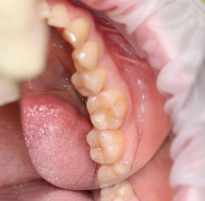 Состояние зубов 2.1 и 2.2 до реставрации