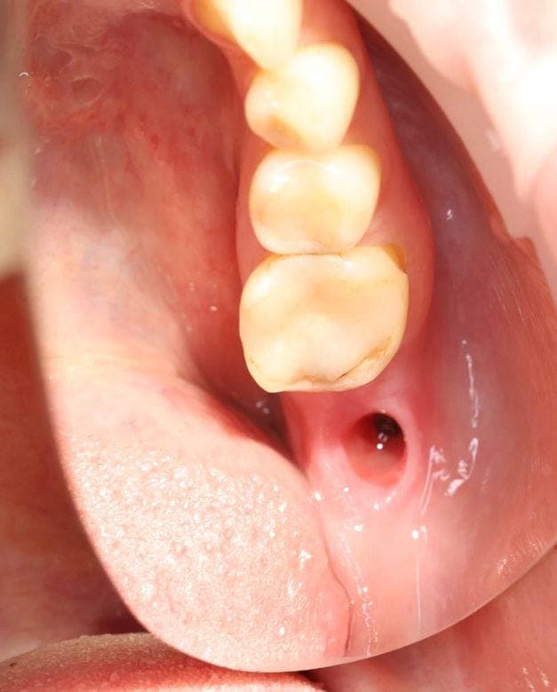 Прямые до реставрации зуба 4.6