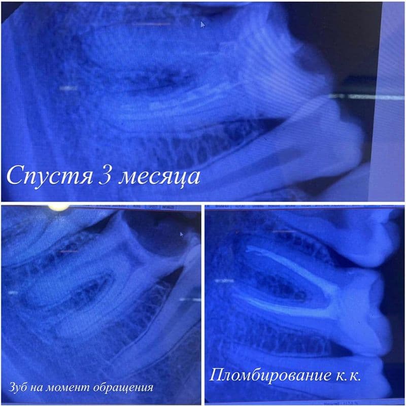 Состояние зубов 2.1 и 2.2 до реставрации