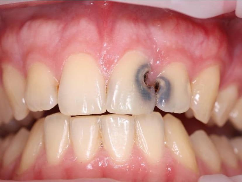 Состояние зубов 2.1 и 2.2 до реставрации