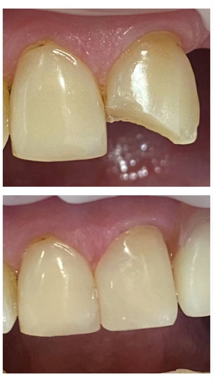 Состояние зубов 2.1 и 2.2 до реставрации